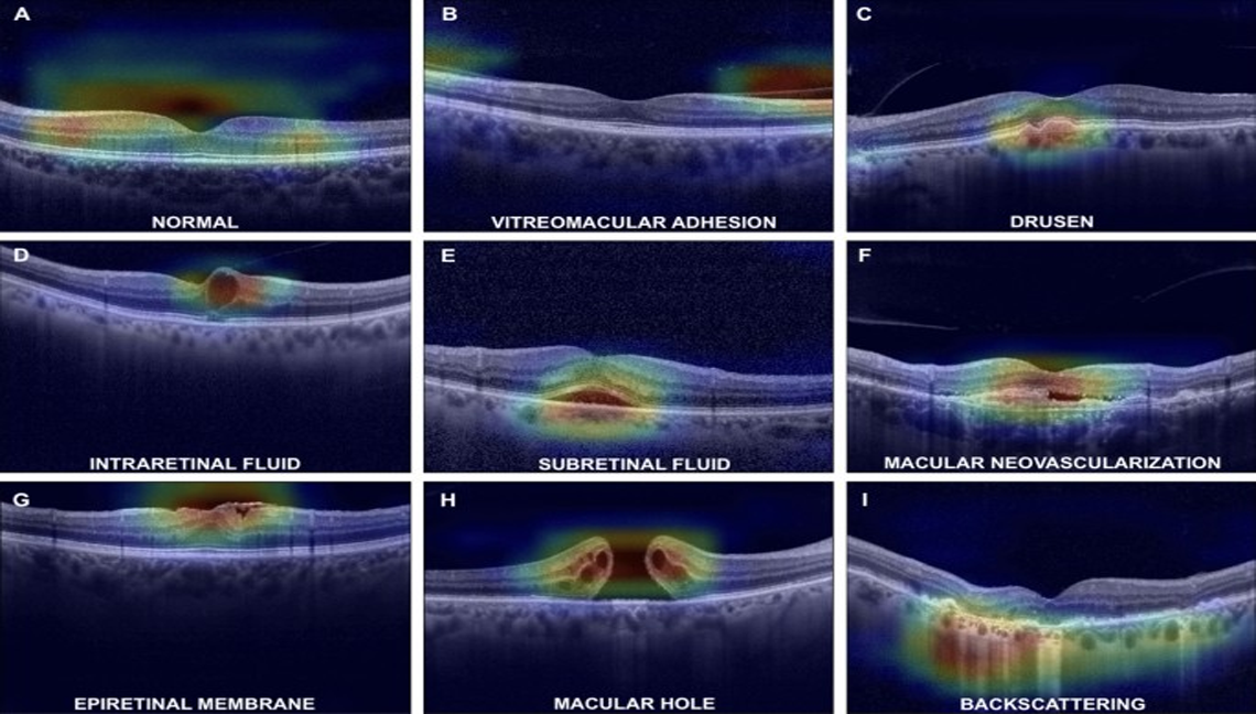OCT Scan for All Retinal Diseases